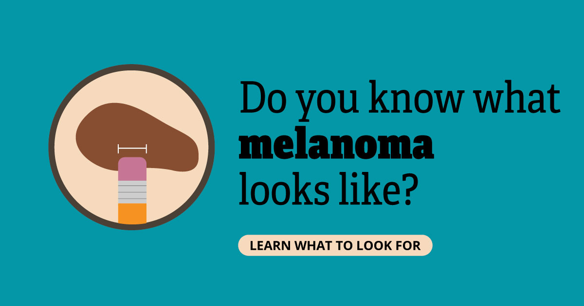 Do you know what melanoma looks like? Learn what to look for.